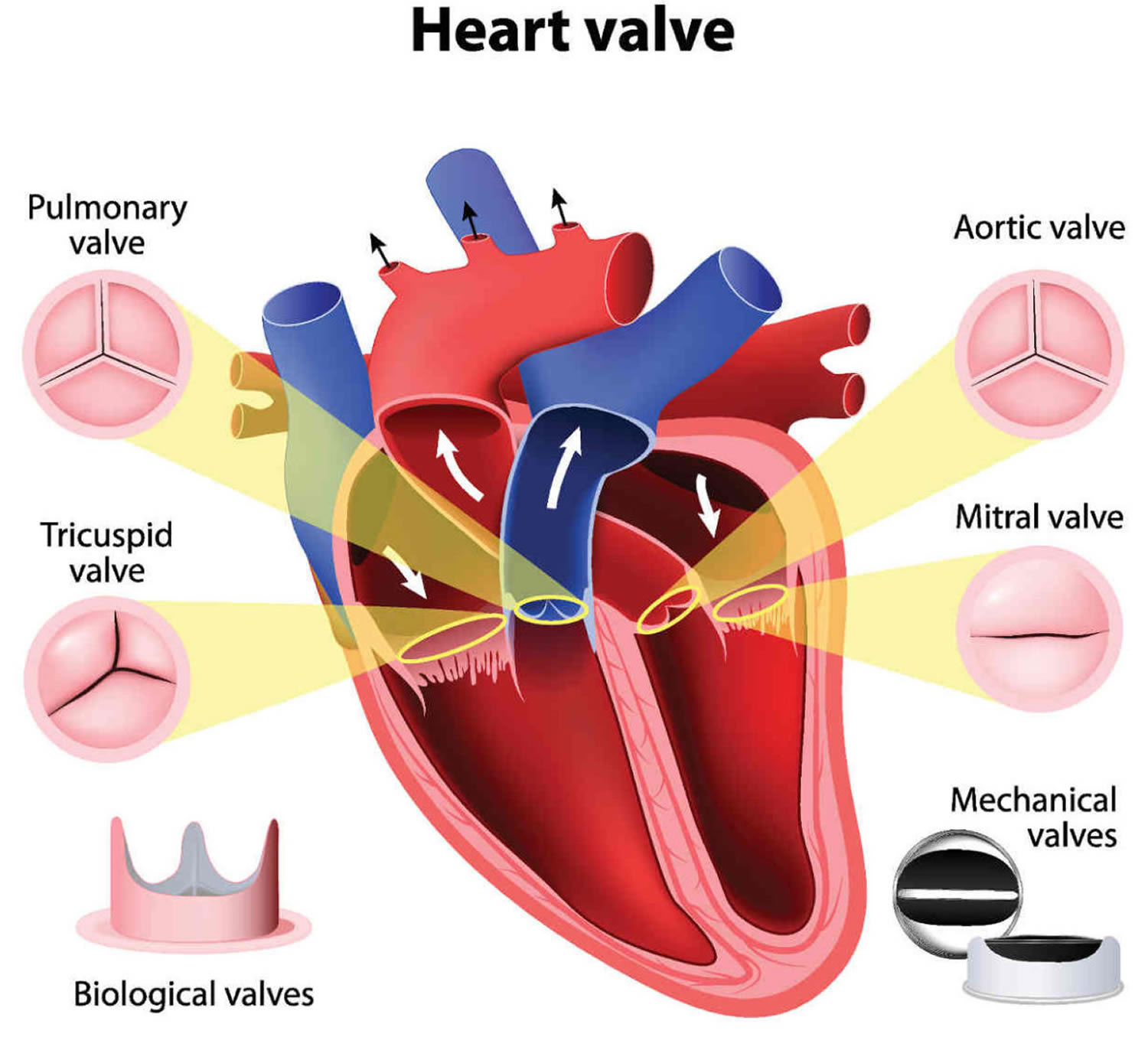 aortic-valve-regurgitation-vejthani-hospital-jci-accredited